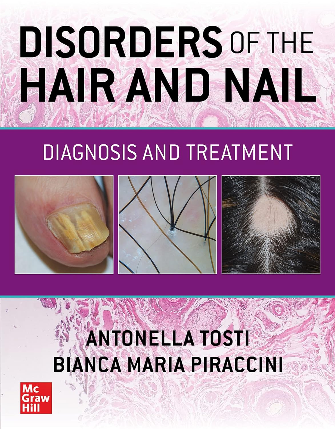 Download Book Disorders of the Hair and Nail: Diagnosis and Treatment, Antonella Tosti; Bianca Maria Piraccini, B0BTDWGXWW, 1260462471, 126046248X, 9781260462470, 9781260462487, 978-1260462470, 978-1260462487