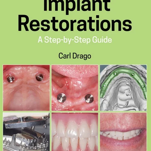 Implant Restorations: A Step–by–Step Guide