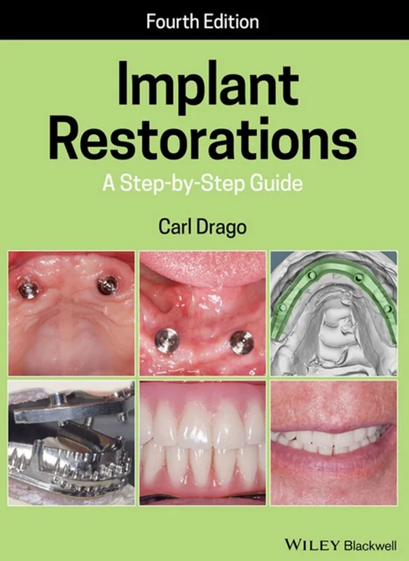 Implant Restorations: A Step–by–Step Guide