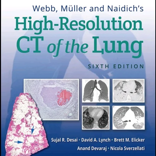 Webb, Müller and Naidich’s High-Resolution CT of the Lung