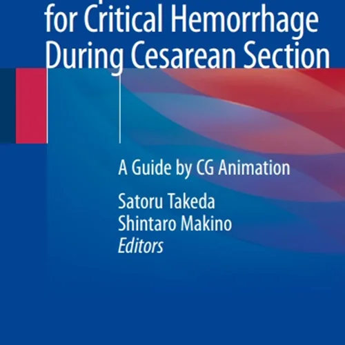 Compression Sutures for Critical Hemorrhage During Cesarean Section: A Guide by CG Animation