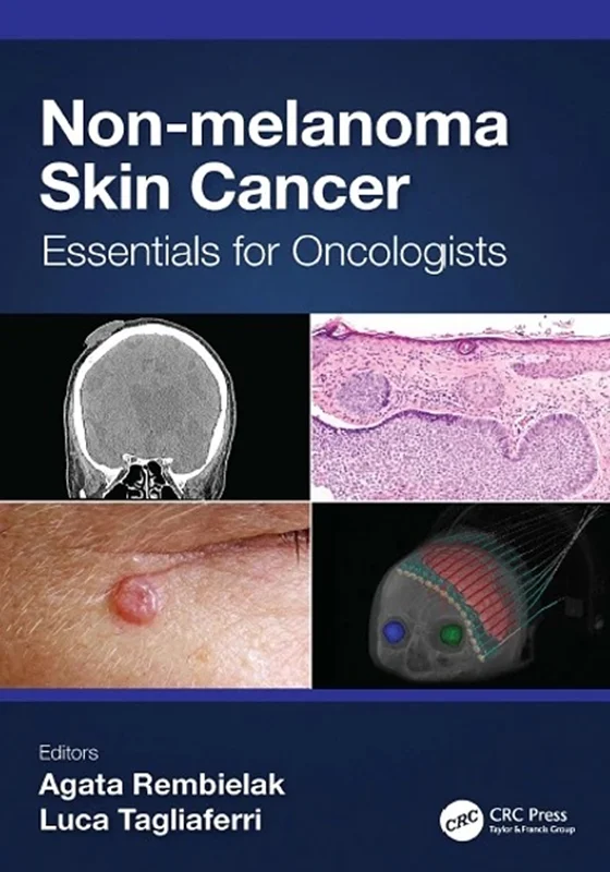 Non-melanoma Skin Cancer: Essentials for Oncologists