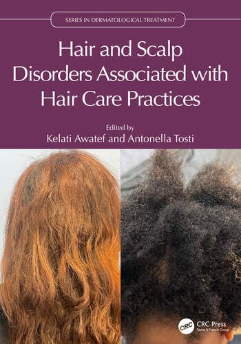Hair and Scalp Disorders Associated with Hair Care Practices Edited By Kelati Awatef, Antonella Tosti