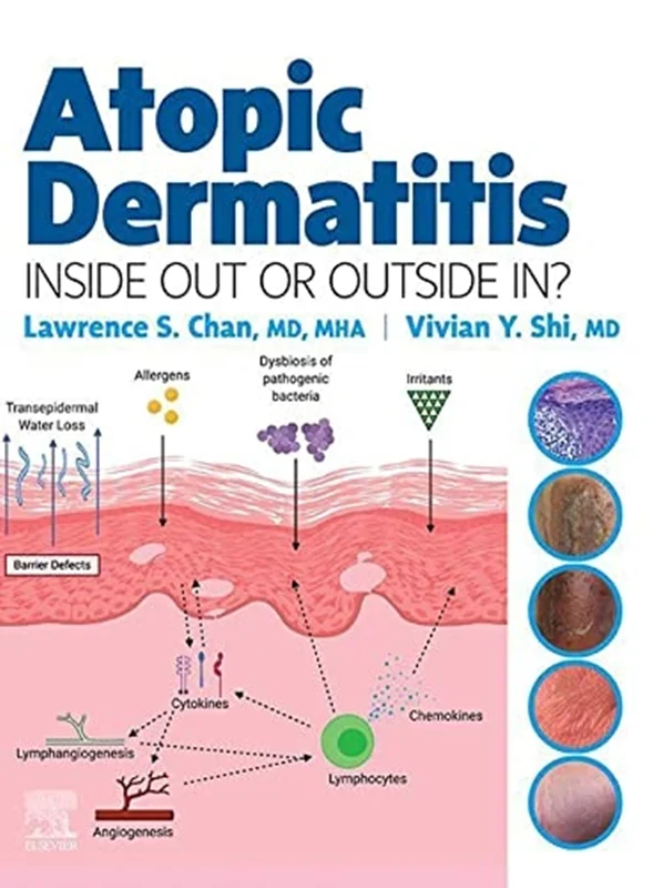 Atopic Dermatitis: Inside Out or Outside In?
